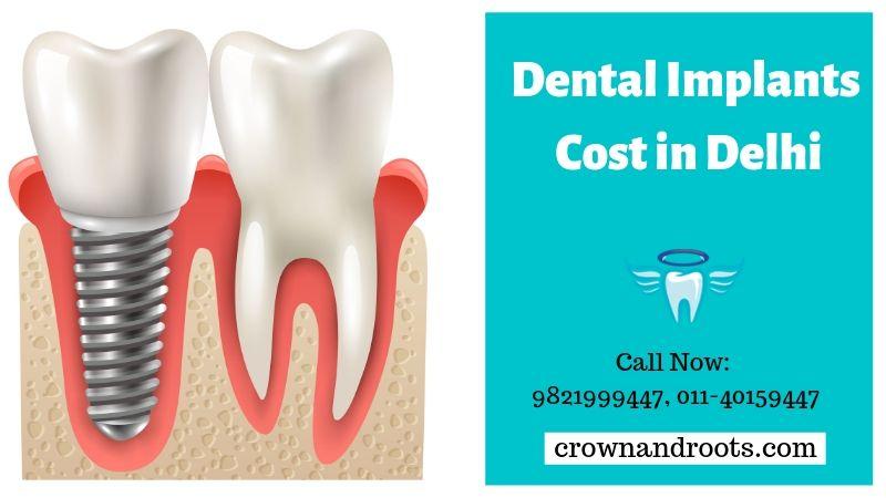 Dental Implants Cost in Delhi | Crownandroots